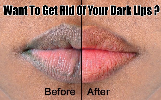 WANT TO GET RID OF YOUR DARK LIPS ? HERE'S COMPLETE GUIDE TO PREVENT AND TREAT THEM