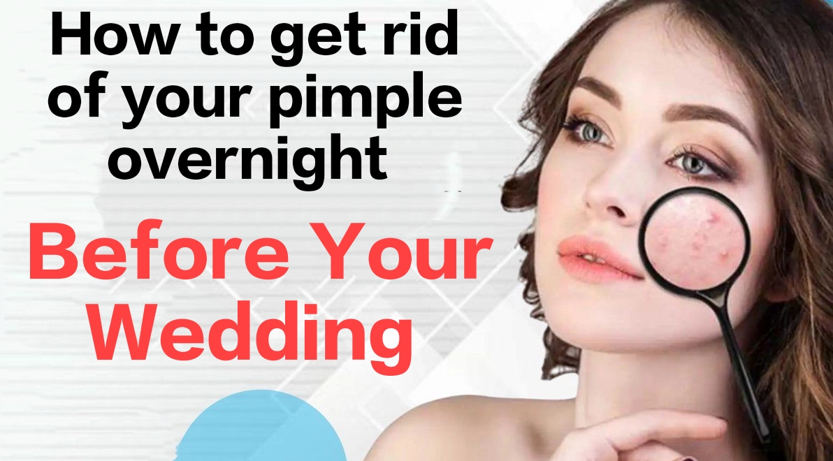 Treating acne overnight—especially before your wedding—requires a calm but effective approach.